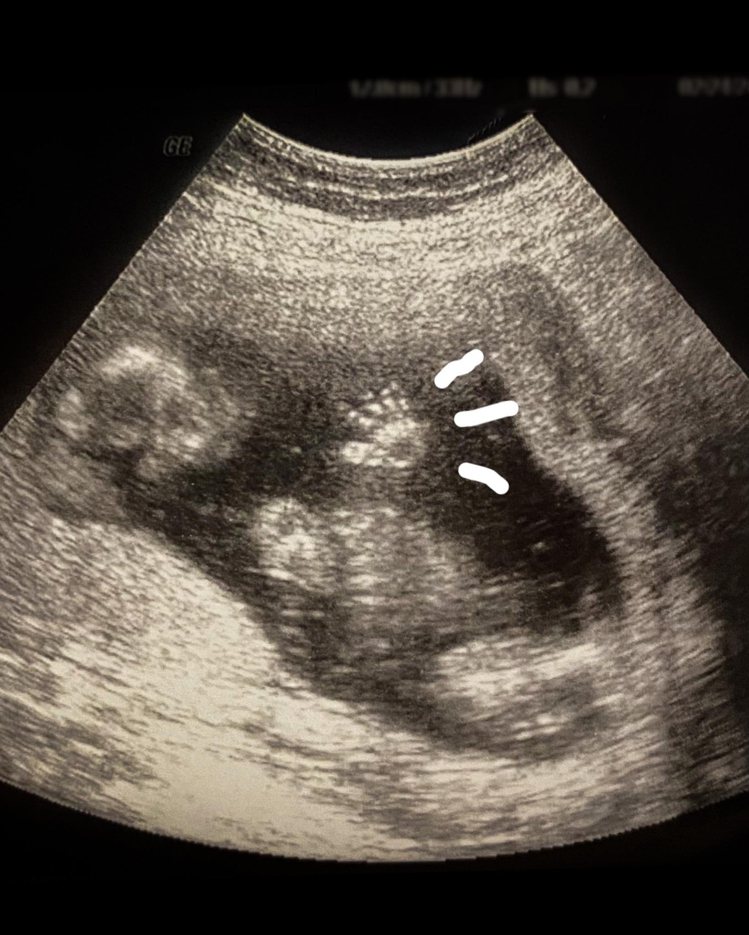 歐陽靖在臉書大方公開寶寶超音波圖片，清楚手掌形狀也令網友開心送上祝福。圖 / 翻攝自FB 歐陽靖・裏東京生存記。