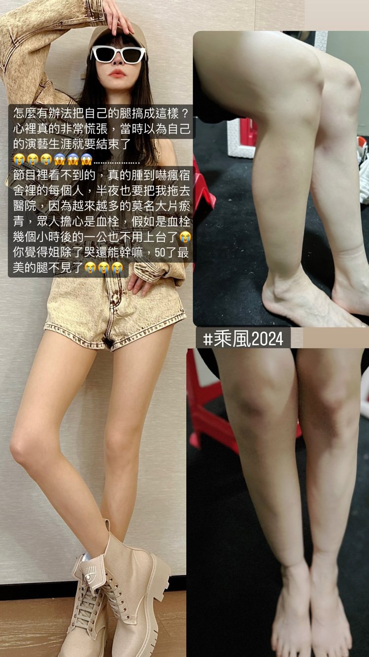 謝金燕參加「乘風2024」練舞練到腿部腫脹瘀青。 圖／擷自IG