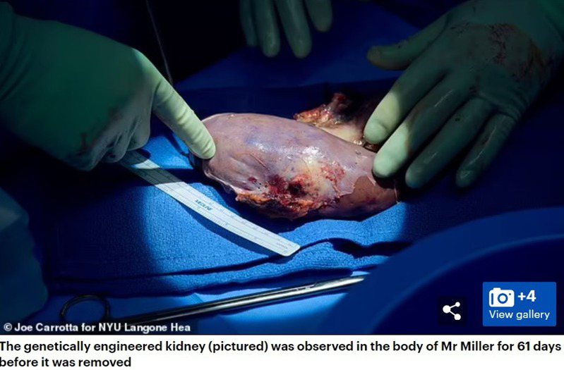 豬腎在米勒體內成功運作61天，移除時也仍是健康正常的狀態。圖擷自每日郵報