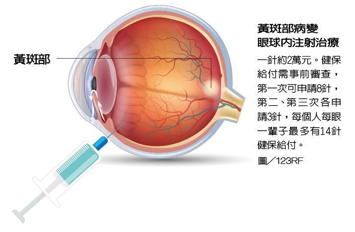 黃斑部病變眼球內注射治療。圖/123RF  製表/元氣周報