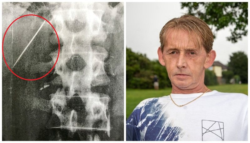 英国男子普莱斯顿（右）的肝脏卡着一根缝衣针（左，红圈）已经长达至少15年了，但连他自己都不知道这到底是怎么一回事。画面翻摄：The Sun(photo:UDN)
