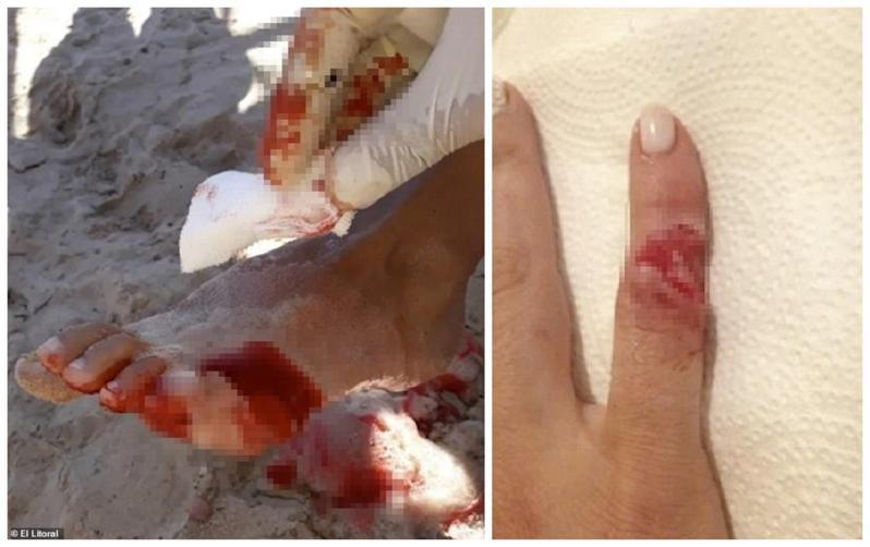 阿根廷日前发生民众为躲避午后酷热而跑进河里游泳与沖凉，却遭受食人鱼的攻击。影像可见医护人员正照料一位脚上伤口流着鲜血的伤者，另一位伤者是手指被咬掉一大块肉。画面翻摄：MAILONLINE(photo:UDN)