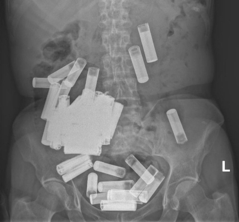 爱尔兰1名66岁女子为了自残，刻意吞下55粒AA型及AAA型电池，引起弥漫性腹痛和厌食而送院。（「Irish Medical Journal」图片）(photo:UDN)