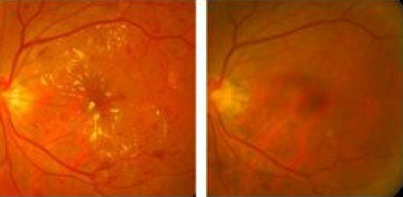 糖尿病黃斑部水腫治療前(左)、後之眼底照片比較。黃斑部黃色滲出物及眼底出血明顯減少(右)。圖／基隆長庚醫院提供