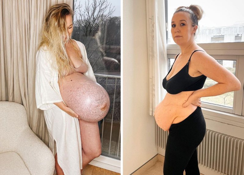 米歇拉懷三胞胎時，肚子被撐成圓柱狀，形狀相當奇特（左）；她也分產後的身體狀況（右）。圖擷自michellameiermorsi
 IG