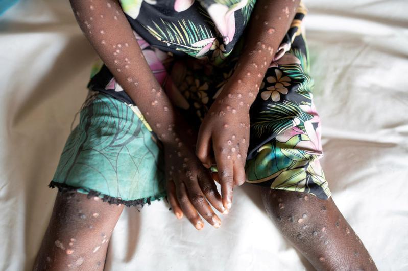 中國7月通報猴痘數量，較6月大增。圖為早前非洲中部國家剛果一名感染猴痘病毒的男童發病後症狀。路透