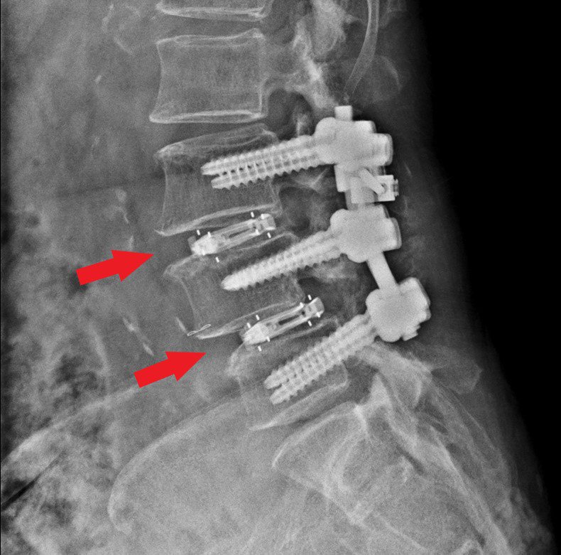 婦人接受一次性手術置入兩組新式撐開式支架，治療連續椎間盤突出併脊椎滑脫症。記者吳慧芬／翻攝