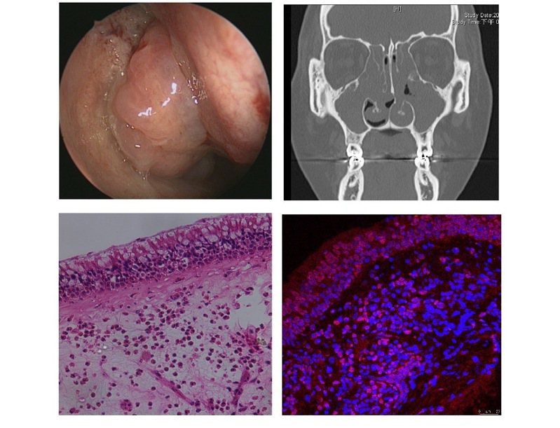 第二型慢性鼻竇炎併鼻息肉的內視鏡（左上）、電腦斷層（右上）、顯微鏡（下方二張）影像。圖／林口長庚醫院提供