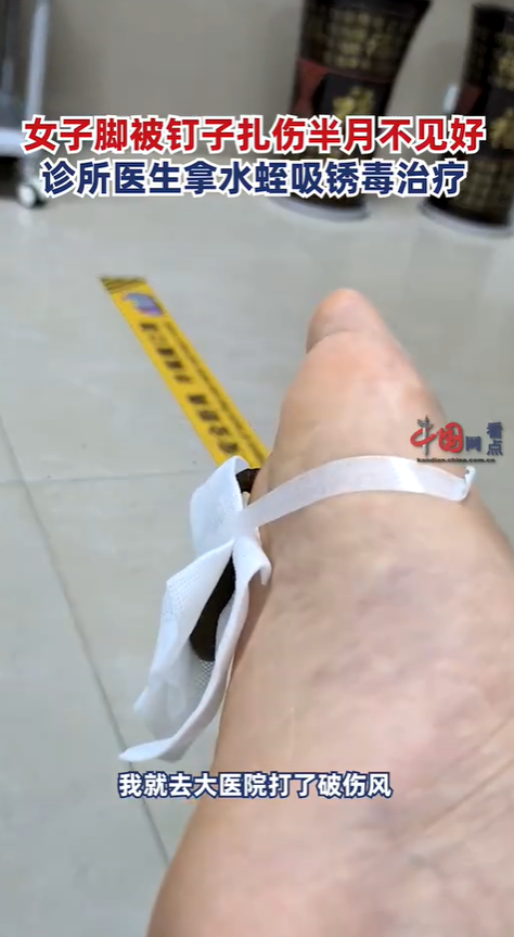 大陸重慶有名女子分享，自己的腳因被釘子扎傷，醫生便拿出7至8公分的「醫用水蛭」，幫她治療。圖／擷自「中國網看點」