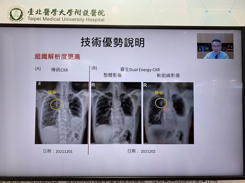 北醫附醫胸腔內科主任周百謙研發「衛星X光檢查中心」，該產品是以「三層雙能」的方式，讓民眾照一次X光，即可顯影三種X光片。記者陳雨鑫／攝影