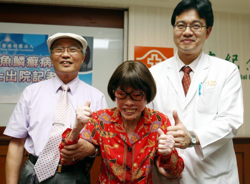 馬來西亞魚鱗癬病患張四妹（中）2014年在長庚醫院皮膚科醫師官裕宗（左）與骨科部關節重建科主任謝邦鑫（右）的配合下，順利完置換人工髖關節手術。聯合報系資料照