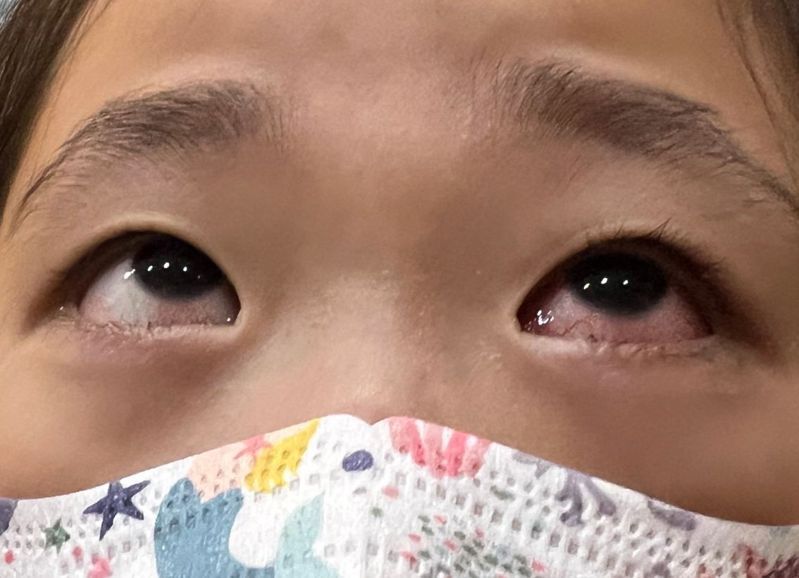 兒科醫師施勝桓說明，腺病毒臨床特徵是高燒合併單眼結膜炎。圖／施勝桓提供