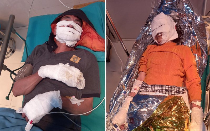 越南一對夫妻因手機爆炸嚴重燒傷。 圖擷自宣光省雄王綜合醫院臉書