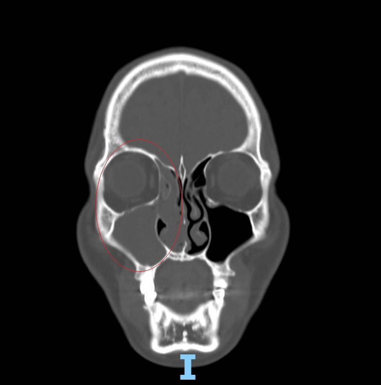 彰化县黄姓病人的电脑断层检查，左鼻腔黑色代表畅通充满空气，右鼻腔被乳突瘤塞住，只剩一点点空间（黑点）。图／卫福部彰化医院提供
