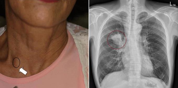 1名患者在鎖骨上窩摸到硬的淋巴結，檢查竟發現肺部長腫瘤。圖／取自蘇一峰臉書