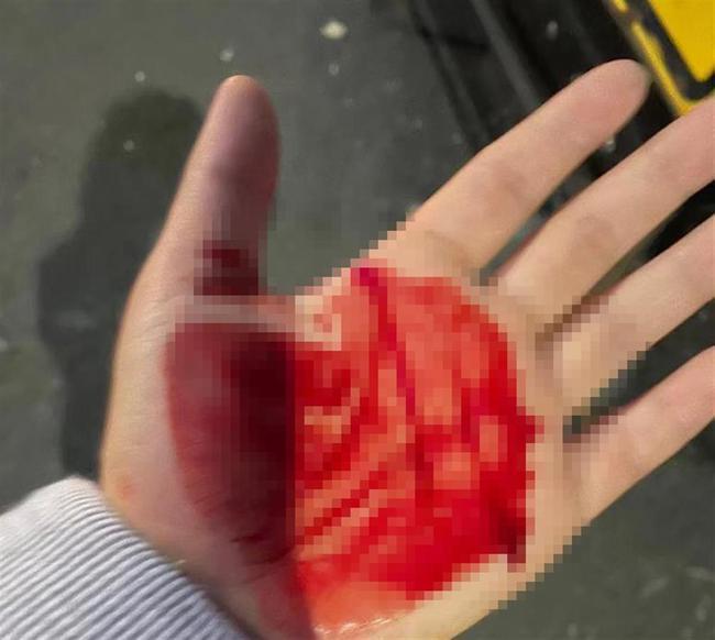 中国留学生在英国大学校园莫名被人砸破头，一手是血。（取材自极目新闻／受访者供图）(photo:UDN)