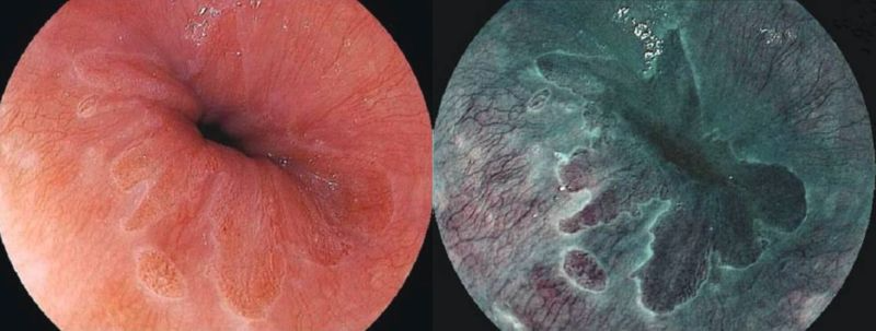 右圖為高解析度BLI內視鏡影像系統，可很清楚看到胃食道交接處粘膜及微血管非常細微...