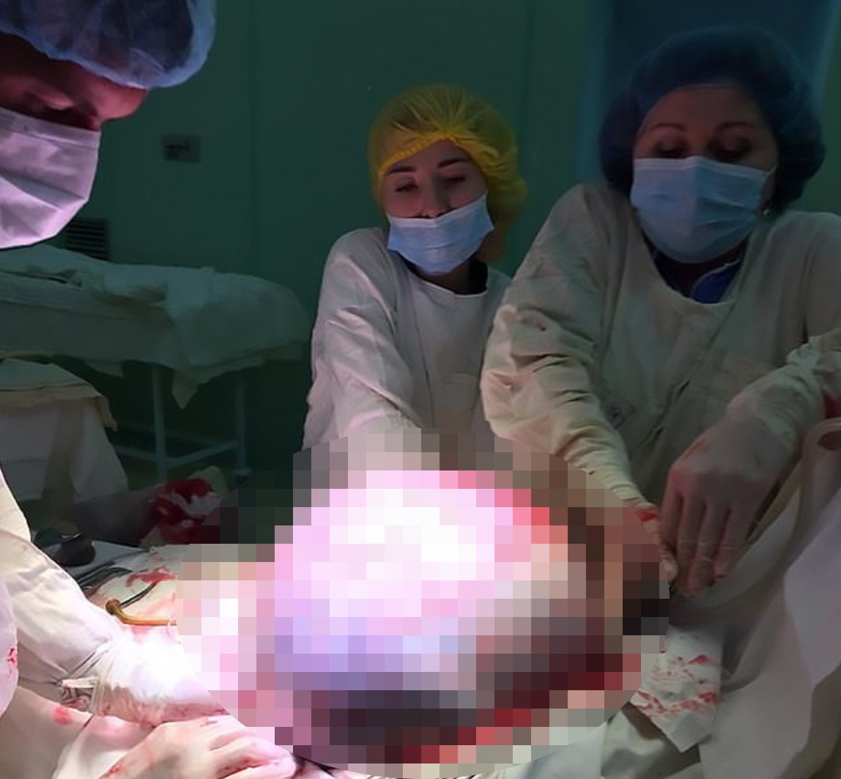 醫生從婦人腹中取出重達25公斤沙灘球大小的卵巢瘤。圖擷自<a href="https://www.dailymail.co.uk/health/article-7398855/Surgeons-Russia-remove-beach-ball-sized-tumour-59-year-old-womans-ovary.html" target="_blank"><font color="#0074ad">dailynews</font></a>