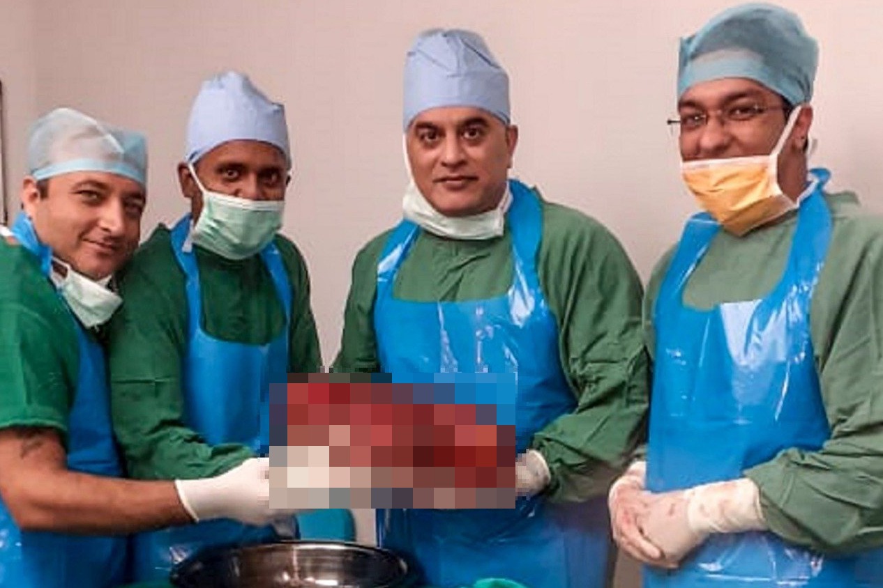 印度醫生切除一顆重達7.4公斤腎臟 可破金氏紀錄 | 聯合新聞網