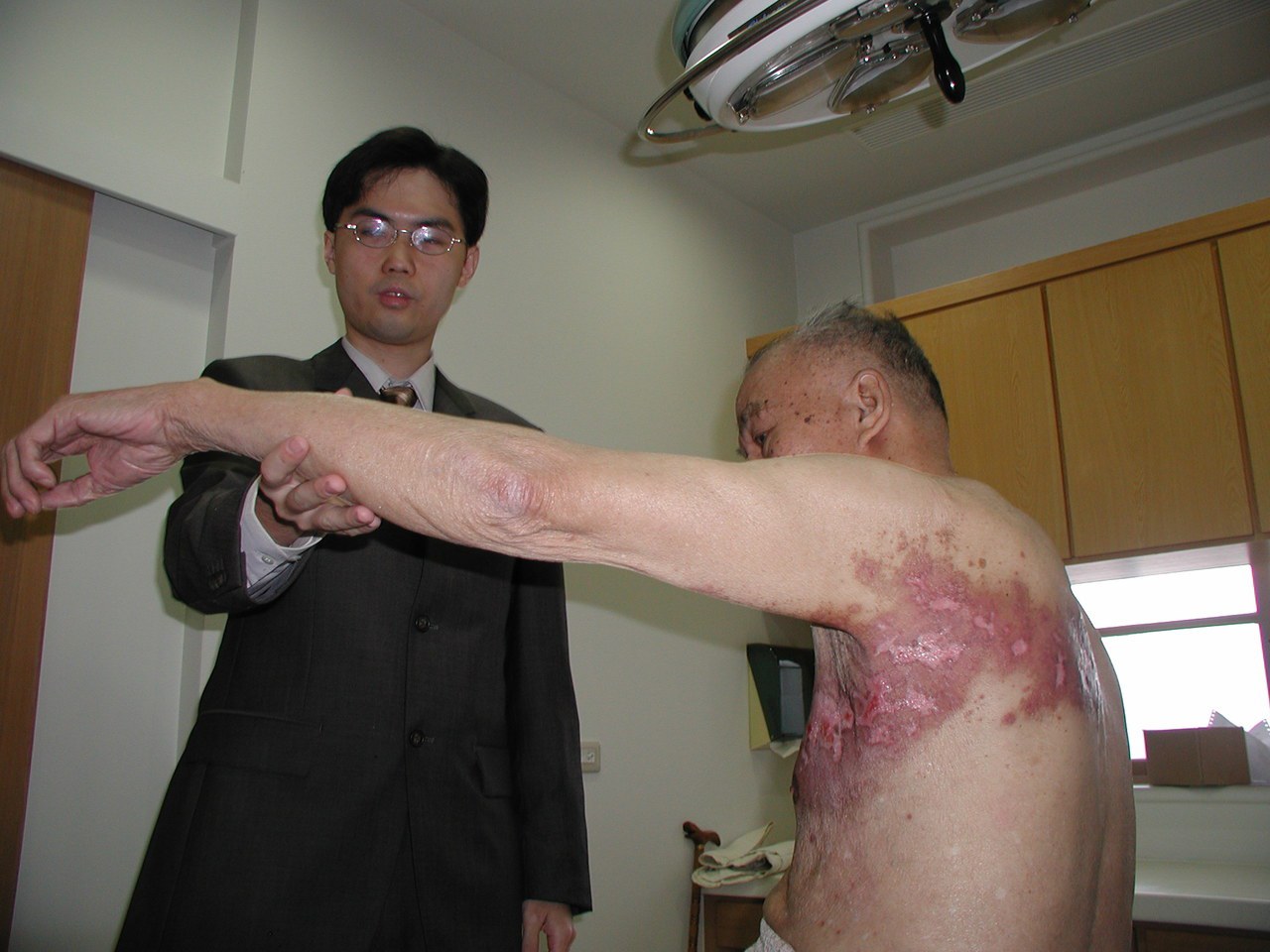 台北長庚皮膚科主治醫師黃毓惠表示，皮蛇就是醫學上所說的帶狀皰疹，多好發於55歲到60歲以上的老年人。聯合報系資料照／記者陳積碩攝影