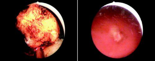 左：銩雷射之攝護腺汽化切割過程。<br>右：經切割後，掉落於膀胱中的組織。（記者陳立凱／攝影）