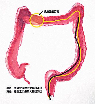 台中市60歲婦人第一次做大腸鏡檢查，深度70公分未發現腫廇（黑線顯示）；第二次加深20公分（黃線顯示），赫然發現腫瘤。（記者胡宗鳳／攝影）