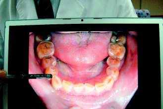 不少磨牙患者都在齒面上琺瑯質都磨平了或下巴痠痛不舒服，無法進食、說話才來就診。（記者胡宗鳳／攝影）