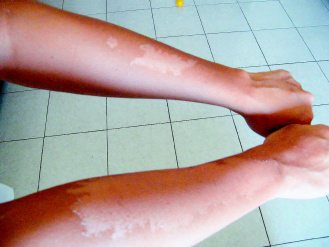 長期曝曬輕者導致脫皮，嚴重可能罹患皮膚癌。（記者施鴻基／攝影）