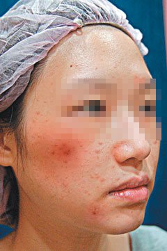陳小姐仿照醫療雷射原理以釘書針刺臉，希望淡化痘疤，反而紅腫發炎。（圖／盧靜怡醫師提供）
