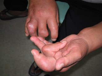 痛風病患的手指關節腫脹變形，猶如生薑。（聯合報系資料照片）