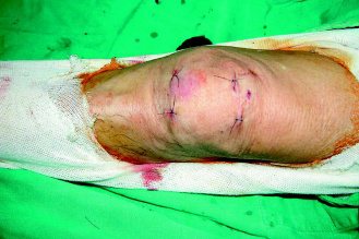 署立台南醫院骨科主任楊哲忠自創的膝骨折固定術，不必切開，表皮上只看到4處小孔。（圖／楊哲忠提供）