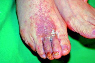 一名阿嬤塗抹外用藥水治療灰指甲，卻引發腳背滿是紅疹的過敏反應。（李承鴻提供）