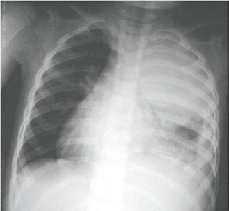 大葉性肺炎，患者清澈的肺葉變成一片白霧，還合併膿胸症狀。（照片提供／李秉穎醫師）