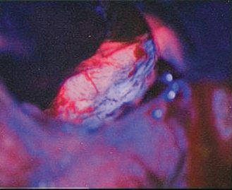 台北榮總最近引進「螢光導引切除術」，病人口服含螢光劑藥物後，癌細胞在藍光照射下，會呈現紅色。（榮總／提供）