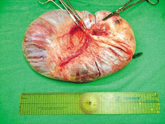 郭成興醫師從阿嬤卵巢取出的黏液腺瘤重達8公斤。（記者羅紹平／翻攝郭成興簡報圖片）