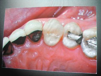 奇美醫學中心贗復牙科主任張瑞忠強調，不論是金屬（右起）、全瓷牙或金屬瓷牙或植牙，都遠不及真牙好用。（記者周宗禎／攝影）