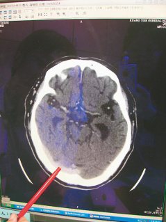 李斯特菌侵入腦部，造成白色區塊腦水腫。 照片／光田醫院提供
