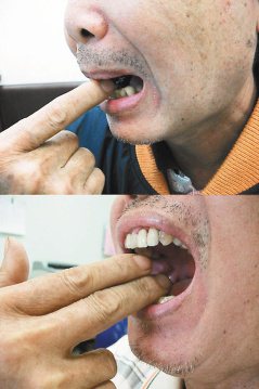 到高雄長庚求診的59歲男子，原本只能張口一指寬，治療後顳頜關節活動度提高，不再疼痛，重拾生活品質。 記者王昭月／翻攝