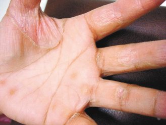 手指側面刺癢，產生水泡，甚至脫皮、疼痛，夏天更嚴重，皮膚乾裂疼痛，是汗皰疹的症狀。 圖／李聰界醫師提供