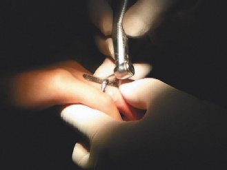 竹東鎮18歲彭姓女學生右手無名指被蚊子一叮紅腫，鋼戒卡在手指取不下來，找上牙醫師求助，以磨牙機切割才取下。 記者王慧瑛／翻攝