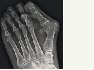 大腳趾X光片下可見第一蹠骨明顯外翻。 江昭慶醫師／提供