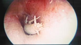 男子耳鳴就醫，照內視鏡發現蟑螂幼蟲。 圖／馬偕醫院提供