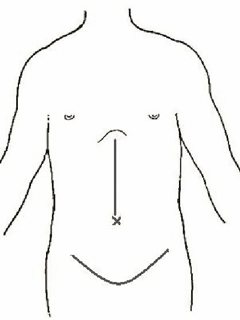 傳統手術的傷口較大，腹部手術傷口至少15至20公分。 圖／李博彰醫師提供