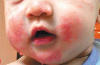 黃小妹的口水疹讓兩頰皮膚發炎紅腫、不舒服。 記者張嘉芳／攝影
