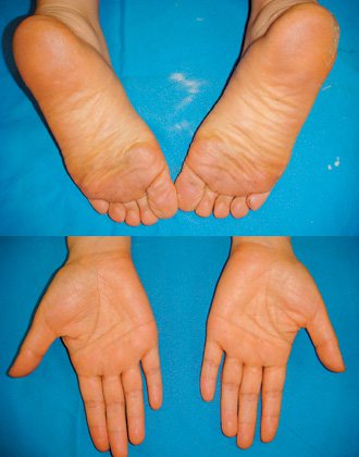 胡蘿蔔素血症患者的手掌、腳掌特別黃。 圖／呂佩璇醫師提供