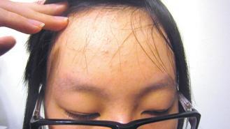 一大片瀏海遮住額頭毛細孔，讓少女額頭的痘痘冒不停。 記者許玉娟／攝影