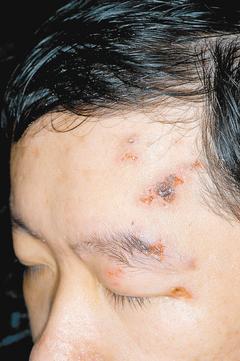 熬夜趕報告，張先生的左側額頭冒出帶狀&#30129;疹。 台北榮總/提供(非報系)