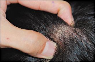 18歲女生罹患罕見的脂腫性頭皮，導致脂腫性脫髮，頭皮摸起來軟軟的，有如果凍、布丁。 圖/林口長庚醫院提供
