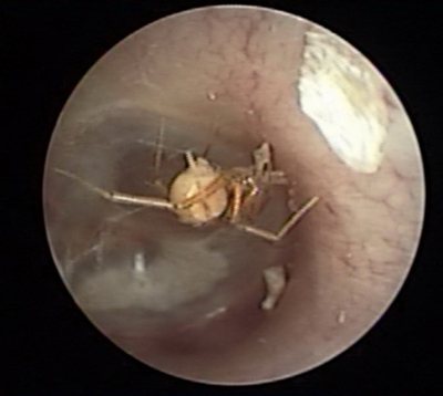 醫師劉博仁在婦人的耳道內，發現一隻活生生的小蜘蛛，小蜘蛛在耳道內已結成網。（圖／劉博仁提供）