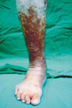 73歲老婦腳部傷口發黑潰瘍，久久不癒，原來是嚴重靜脈曲張。 圖／周宏滔提供